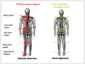 Skeletal display of body alignment with and without proper biomechanical support.